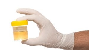 How to Get Sugar Out of Urine for Dot Physical